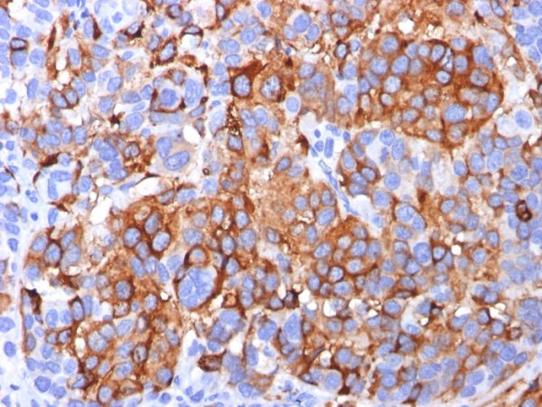 Formalin-fixed, paraffin-embedded human Melanoma stained with MART-1 / Melan-A Mouse Monoclonal Antibody (A103).