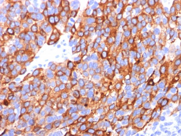 Formalin-fixed, paraffin-embedded human Melanoma stained with MART-1 / Melan-A Monoclonal Antibody (A103+M2-7C10+M2-9E3).