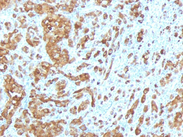 Formalin-fixed, paraffin-embedded human Melanoma stained with Melan-A / MART-1 Mouse Monoclonal Antibody (MLANA/788).
