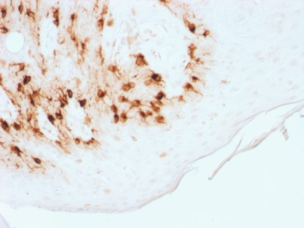 Formalin-fixed, paraffin-embedded human Skin stained with MART-1 Rabbit Recombinant Monoclonal Antibody (MLANA/1761R) (HRP-DAB).