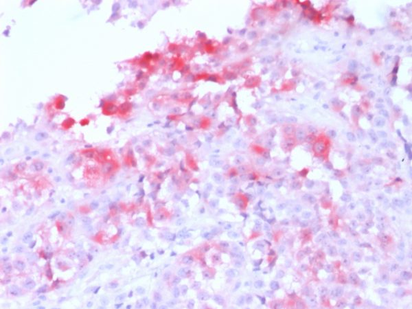Formalin-fixed, paraffin-embedded human Melanoma stained with MART-1 Rabbit Recombinant Monoclonal Antibody (MLANA/1761R) (AP-Fast Red).