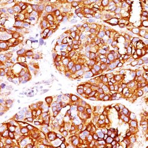 Formalin-fixed, paraffin-embedded human Melanoma stained with MART-1 Rabbit Recombinant Monoclonal Antibody (MLANA/1409R).