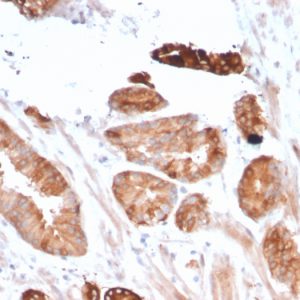 Formalin-fixed, paraffin-embedded human Breast Carcinoma stained with Flt3 / CD135 Mouse Monoclonal Antibody (FLT3/2458).