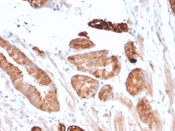 Formalin-fixed, paraffin-embedded human Breast Carcinoma stained with Flt3 / CD135 Mouse Monoclonal Antibody (FLT3/2458).