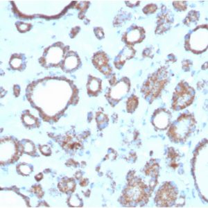 Formalin-fixed, paraffin-embedded human thyroidstained with DBC2 Mouse Monoclonal Antibody (DBC2/3362).