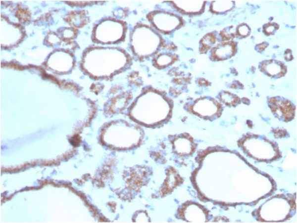 Formalin-fixed, paraffin-embedded human thyroid stained with DBC2 Mouse Monoclonal Antibody (DBC2/3362).