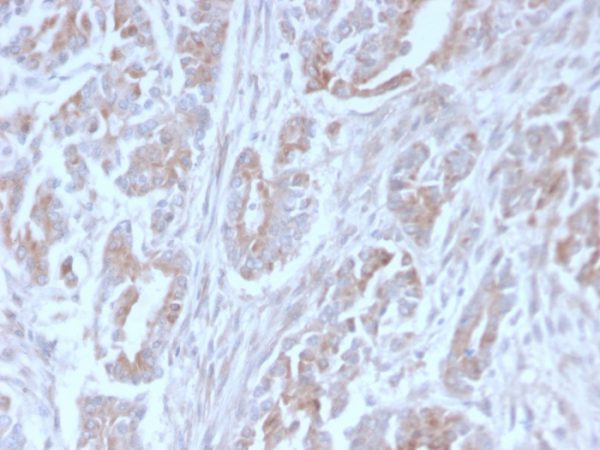 Formalin-fixed, paraffin-embedded human Colon Carcinoma stained with ICOS-L Mouse Monoclonal Antibody (ICOSL/3111).