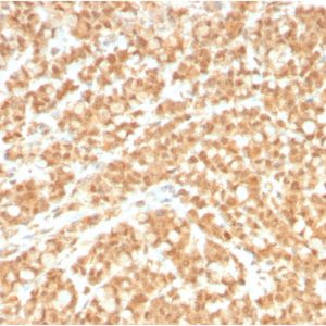 Formalin-fixed, paraffin-embedded human Colon Carcinoma stained with ICOSL-Monospecific Mouse Monoclonal Antibody (ICOSL/3260).