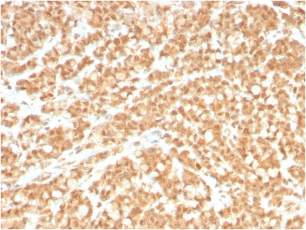 Formalin-fixed, paraffin-embedded human Colon Carcinoma stained with ICOSL-Monospecific Mouse Monoclonal Antibody (ICOSL/3260).