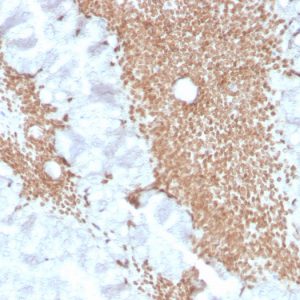 Formalin-fixed, paraffin-embedded human colon carcinoma stained with SATB2 Rabbit Recombinant Monoclonal Antibody (SATB2/4374R).