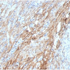 Formalin-fixed, paraffin-embedded human lung stained with Fibronectin Mouse Monoclonal Antibody (FN1/3029)at 2ug/ml RT.HIER: Tris/EDTA, pH9.0, 45min. 2°C: HRP-polymer, 30min. DAB, 5min.