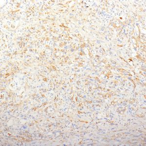Formalin-fixed, paraffin-embedded human Pancreatic Adenocarcinoma stained with Fibronectin Monoclonal Antibody (TV-1).