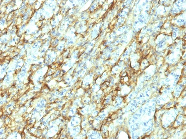 Formalin-fixed, paraffin-embedded human Renal Cell Carcinoma stained with Fibronectin Monoclonal Antibody (568).