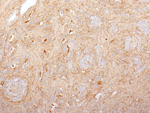 Formalin-fixed, paraffin-embedded human Prostate Carcinoma stained with Fibronectin Mouse Monoclonal Antibody (616).