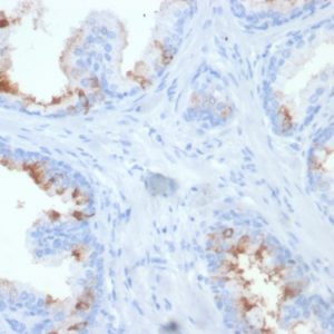 Formalin-fixed, paraffin-embedded human prostate carcinoma stained with FOLH1 Mouse Monoclonal Antibody (FOLH1/2354) at 2ug/ml. HIER: Tris/EDTA, pH9.0, 45min. 2 °: HRP-polymer, 30min. DAB, 5min.