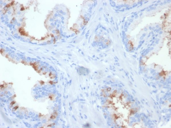 Formalin-fixed, paraffin-embedded human prostate carcinoma stained with FOLH1 Mouse Monoclonal Antibody (FOLH1/2354) at 2ug/ml. HIER: Tris/EDTA, pH9.0, 45min. 2 °: HRP-polymer, 30min. DAB, 5min.