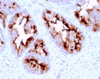 Formalin-fixed, paraffin-embedded human prostate carcinoma stained with FOLH1 (PSMA) Mouse Monoclonal Antibody (FOLH1/2363). HIER: Tris/EDTA, pH9.0, 45min. 2 °: HRP-polymer, 30min. DAB, 5min.