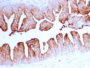 Formalin-fixed, paraffin-embedded human prostate cancer stained with FOLH1 (PSMA) Mouse Monoclonal Antibody (FOLH1/2363).