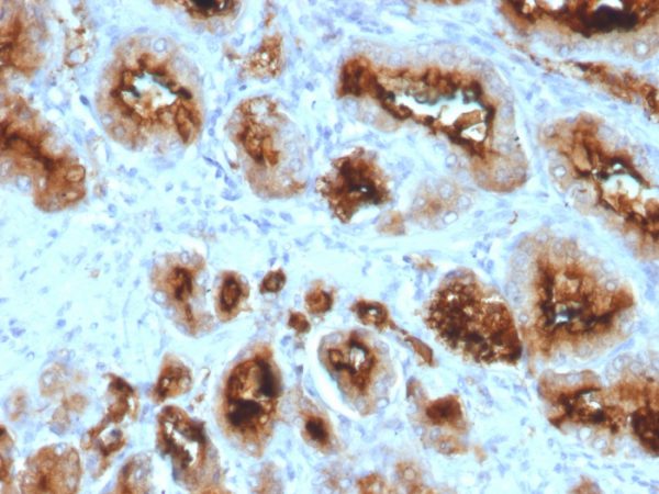 Formalin-fixed, paraffin-embedded human Prostate Carcinoma stained with FOLH1 (PSMA) Mouse Monoclonal Antibody (SPM500).
