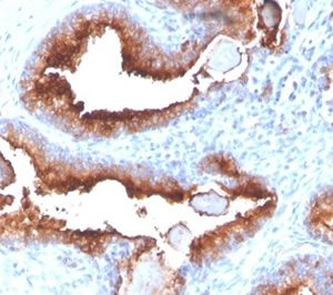 Formalin-fixed, paraffin-embedded human prostate carcinoma stained with FOLH1 (PSMA) Mouse Monoclonal Antibody (FOLH1/3734). HIER: Tris/EDTA, pH9.0, 45min. 2 °: HRP-polymer, 30min. DAB, 5min.
