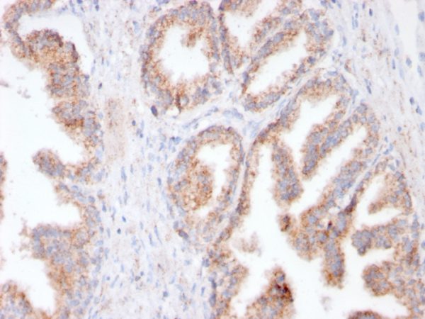 Formalin-fixed, paraffin-embedded human Prostate Carcinoma stained with FOLH1 Rabbit Recombinant Monoclonal Antibody (FOLH1/3149R).