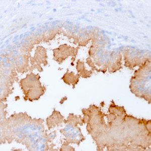 Formalin-fixed, paraffin-embedded human Prostate Carcinoma stained with AMACR Recombinant Mouse Monoclonal Antibody (rAMACR/1864).