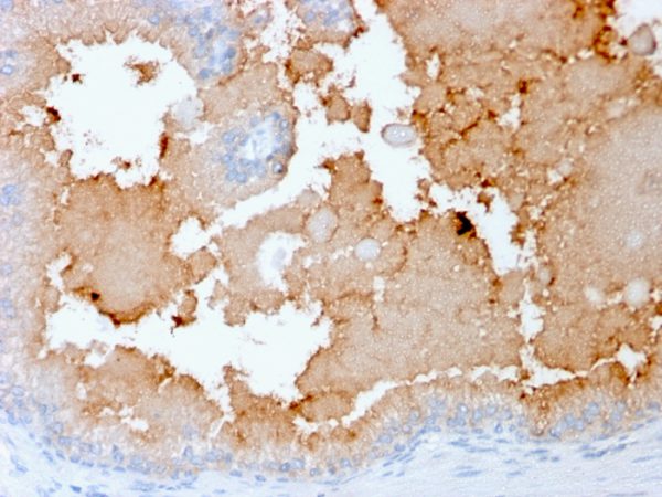 Formalin-fixed, paraffin-embedded human prostate carcinoma stained with  AMACR Recombinant Mouse Monoclonal Antibody (rAMACR/1864). HIER: Tris/EDTA, pH9.0, 45min. 2°C: HRP-polymer, 30min. DAB, 5min.