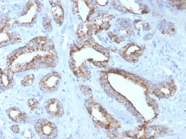 Formalin-fixed, paraffin-embedded human prostate carcinoma stained with AMACR Recombinant Mouse Monoclonal Antibody (rAMACR/4674).