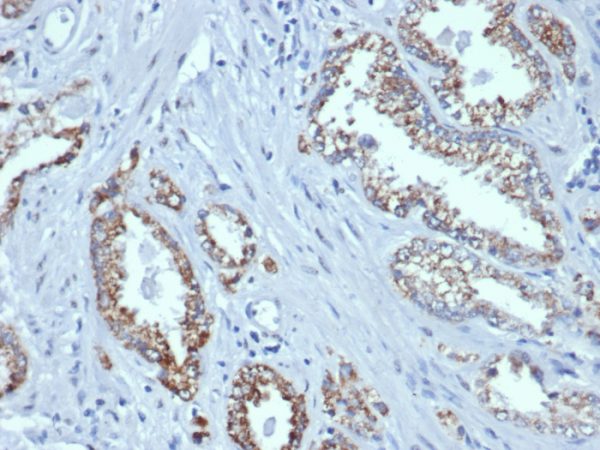 Formalin-fixed, paraffin-embedded human prostate stained with AMACR Recombinant Mouse Monoclonal Antibody (rAMACR/6369).