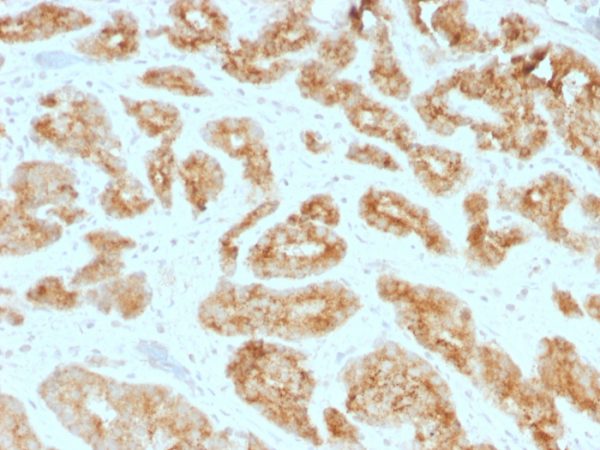 Formalin-fixed, paraffin-embedded human Prostate Carcinoma stained with AMACR / p504S Mouse Monoclonal Antibody (AMACR/1723).