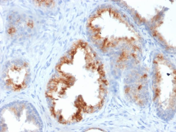 Formalin-fixed, paraffin-embedded human Prostate Carcinoma stained with AMACR / p504S Mouse Monoclonal Antibody (AMACR/1864).