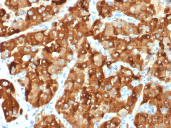 Formalin-fixed, paraffin-embedded human Renal Cell Carcinoma stained with AMACR / p504S Mouse Monoclonal Antibody (AMACR/1864).