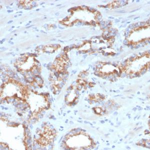 Formalin-fixed, paraffin-embedded human prostate carcinoma stained with AMACR Recombinant Rabbit Monoclonal Antibody (AMACR/4572R).