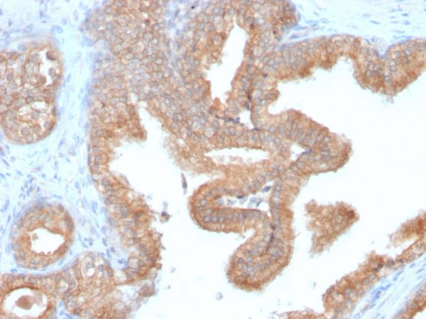 Formalin-fixed, paraffin-embedded human prostate carcinoma stained with AMACR Recombinant Rabbit Monoclonal Antibody (AMACR/2748R).