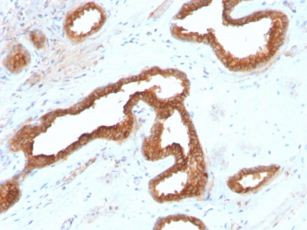 Formalin-fixed, paraffin-embedded human renal cell carcinoma stained with AMACR Recombinant Rabbit Monoclonal Antibody (AMACR/2748R).