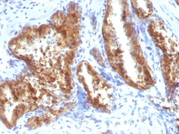 Formalin-fixed, paraffin-embedded human Prostate Carcinoma stained with AMACR / p504S Rabbit Polyclonal Antibody.