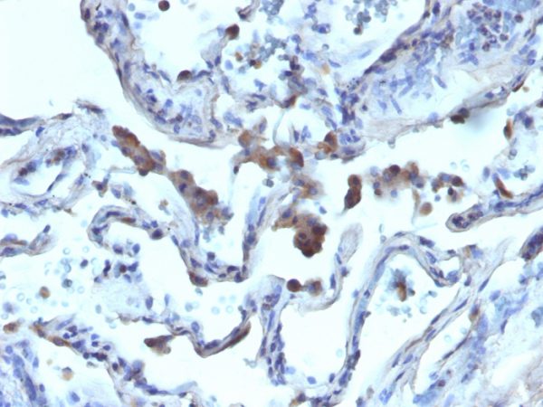 Formalin-fixed, paraffin-embedded human Lung Carcinoma stained with AMACR / p504S Rabbit Polyclonal Antibody.