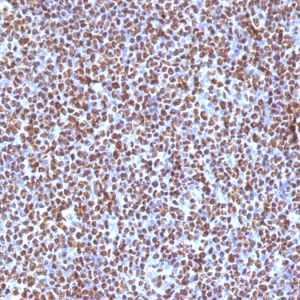 Formalin-fixed, paraffin-embedded human Anaplastic LC Lymphoma stained with ALK-1 Mouse Monoclonal Antibody (ALK/1504).