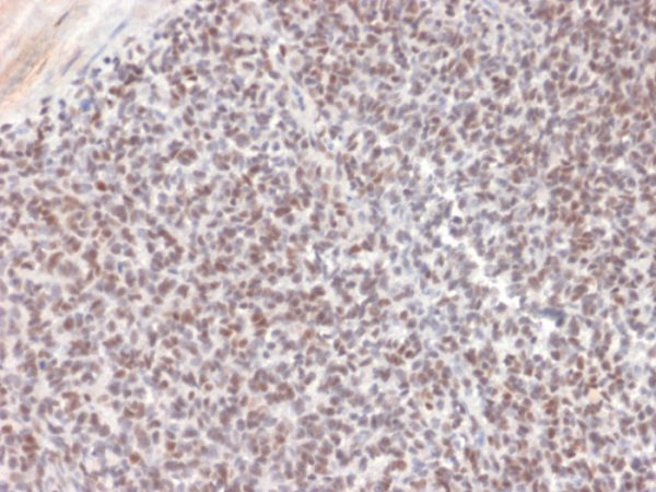 Formalin-fixed, paraffin-embedded human Ewing Sarcoma stained with  ALK-1 Mouse Monoclonal Antibody (ALK/1504).