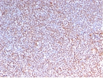 Formalin-fixed, paraffin-embedded human Anaplastic LC Lymphoma stained with ALK-1 Recombinant Mouse Monoclonal Antibody (rALK1/1504).