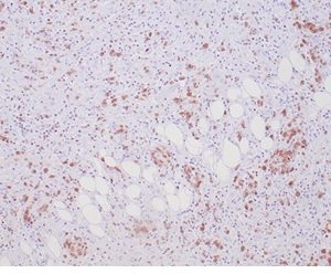 Formalin-fixed, paraffin-embedded human Anaplastic Large Cell Lymphoma stained with ALK1 Recombinant Rabbit Monoclonal Antibody (ALK1/7008R).