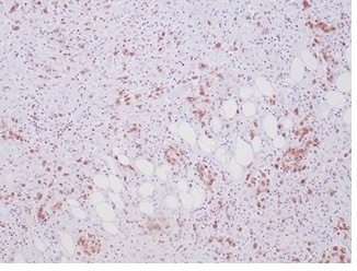 Formalin-fixed, paraffin-embedded human Anaplastic Large Cell Lymphoma stained with ALK1 Recombinant Rabbit Monoclonal Antibody (ALK1/7008R).
