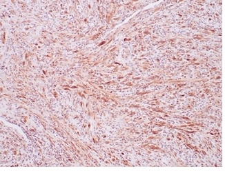 Formalin-fixed, paraffin-embedded human inflammatory myofibroblastic tumor (IMT) with ALK fusion stained with ALK1/7008R.