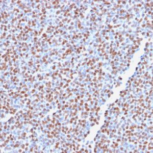 Formalin-fixed, paraffin-embedded human Anaplastic LC Lymphoma stained with ALK-1 Recombinant Rabbit Monoclonal Antibody (ALK1/2766R).