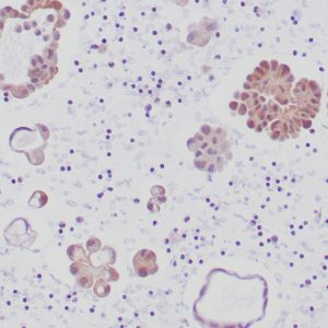Formalin-fixed, paraffin-embedded human lung adenocarcinoma stained with ALK-1 Recombinant Rabbit Antibody (ALK1/6698R) at 2ug/ml in PBS. HIER: Tris/EDTA pH9.0; 95°C/45min. 2°CAb: HRP-Poly:30min. DAB:5min.