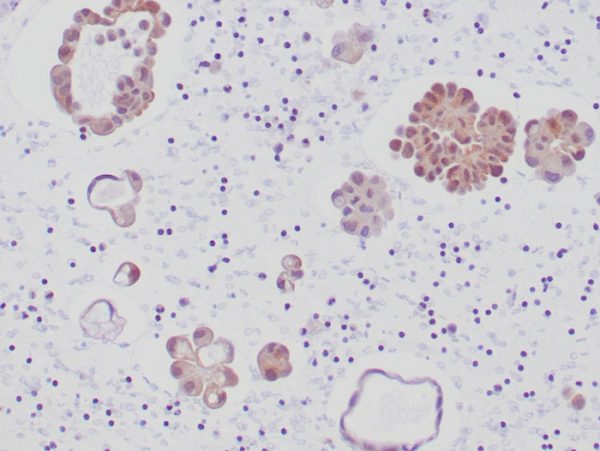 Formalin-fixed, paraffin-embedded human lung adenocarcinoma stained with ALK-1 Recombinant Rabbit Antibody (ALK1/6698R) at 2ug/ml in PBS. HIER: Tris/EDTA pH9.0; 95°C/45min. 2 °Ab: HRP-Poly:30min. DAB:5min.
