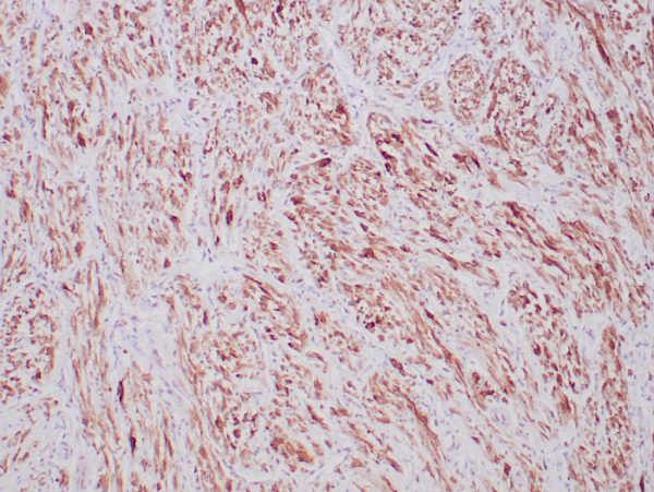 Formalin-fixed, paraffin-embedded human inflammatory myofibroblastic tumor stained with ALK-1 Recombinant Rabbit Antibody (ALK1/6698R) at 2ug/ml. HIER: Tris/EDTA pH9.0; 95°C/45min. 2 °Ab: HRP-Poly:30min. DAB:5min.