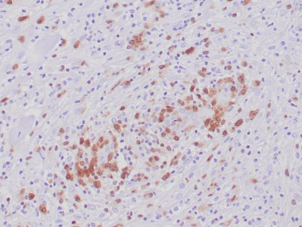 Formalin-fixed, paraffin-embedded human Anaplastic Large Cell Lymphoma stained with ALK-1 Recombinant Rabbit Antibody (ALK1/6698R) at 2ug/ml. HIER: Tris/EDTA pH9.0; 95°C/45min. 2 °Ab: HRP-Poly:30min. DAB:5min.