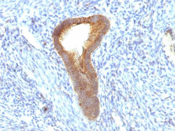Formalin-fixed, paraffin-embedded human Endometrial Carcinoma stained with Alkaline Phosphatase Mouse Monoclonal Antibody (ALPL/597).