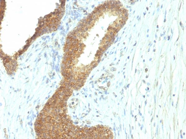 Formalin-fixed, paraffin-embedded human Colon Carcinoma stained with Alkaline Phosphatase Mouse Monoclonal Antibody (ALPL/597).